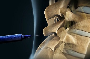 Epidural steroid injection success rates