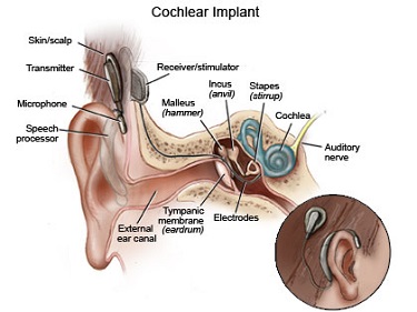 Cochlear-Implants