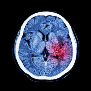 What Causes Non-Penetrating Traumatic Brain Injuries?