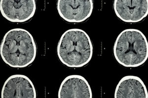 Diffusion Tensor Imaging (DTI): An Advanced Tool In Detecting Traumatic Brain Injury