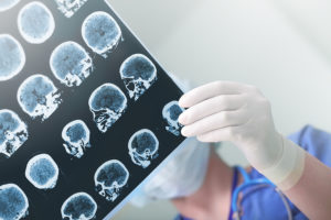 Traumatic Brain Injury Resulting In Neuropsychiatric Problems