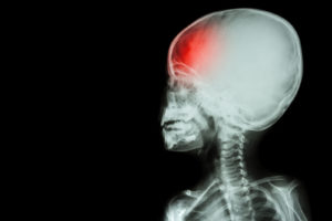 Traumatic Brain Injury in Childhood Linked to Adverse Effects Later in Life