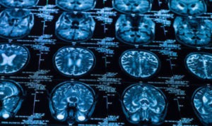 Litigating a Brain Injury Case: Overcoming the term “Mild”
