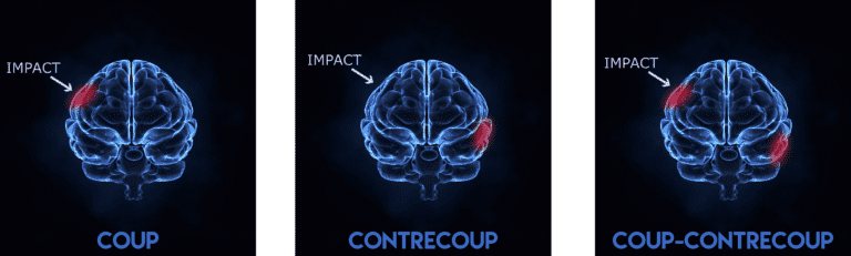 Coup and Contrecoup Brain Injuries