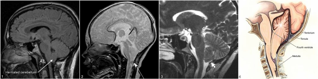 Chiari Malformation: Sudden Onset of Symptoms After Trauma