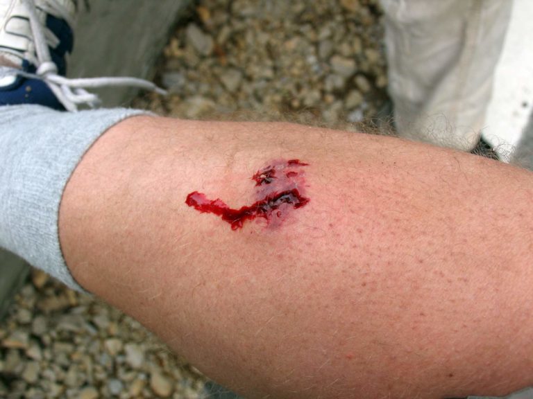 Common Complications from Dog Bite Injuries