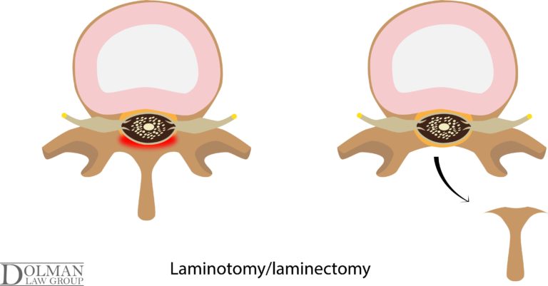 Spinal Disc Extrusion and Protrusion after a Florida Accident