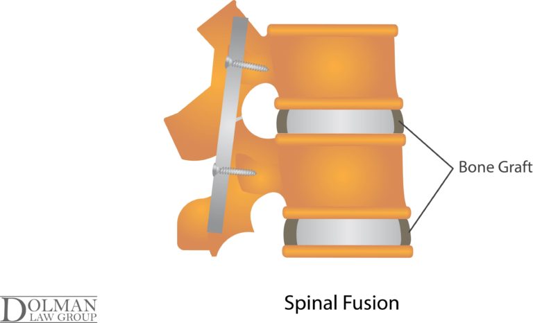 Spinal Disc Extrusion and Protrusion after a Florida Accident