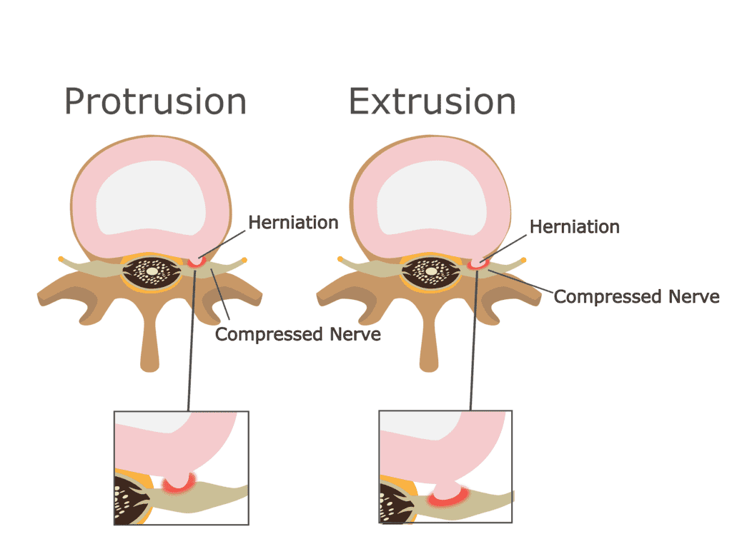 Spinal Disc Extrusion and Protrusion after a Florida Accident