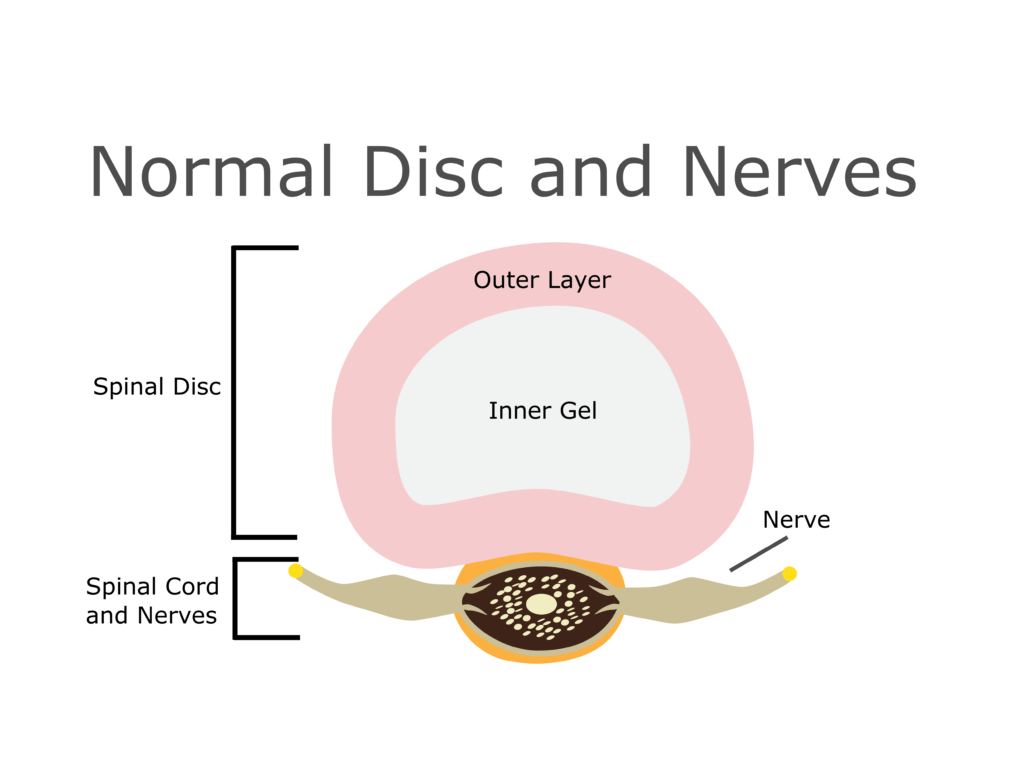 Spinal Disc Extrusion and Protrusion after a Florida Accident