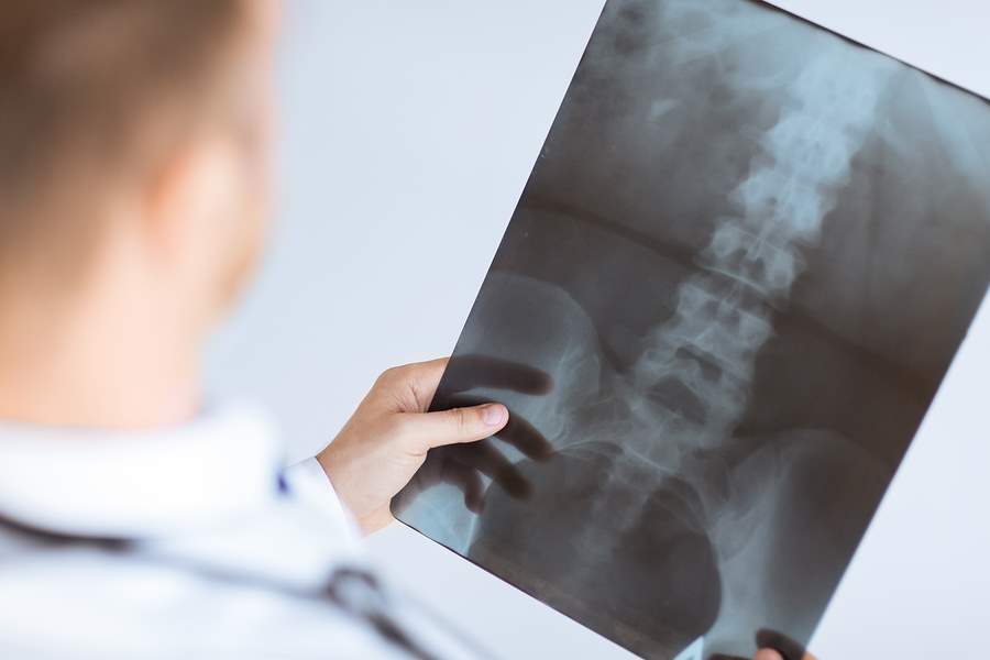 Spinal Disc Extrusion and Protrusion after a Florida Accident
