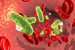 Sepsis Infections Caused by Negligence