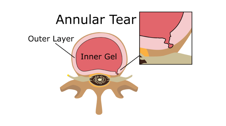 What's Causing Neck & Lower Back Pain after a Car Accident?