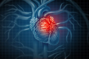 Medical Malpractice and Failure to Diagnose Cardiac Conditions