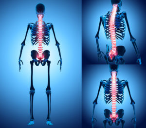 Spinal Cord Injury Lawyers in Florida