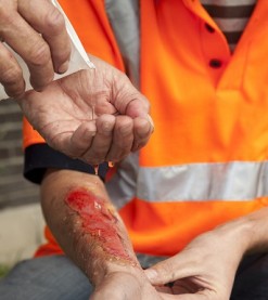 Burn Injury New Port Richey | Dolman Law Group Accident Injury Lawyers, PA