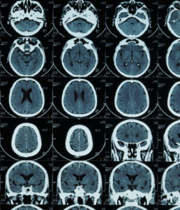 Tampa Brain Injury Attorney Dolmanlaw