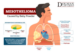 Johnson & Johnson Facing Lawsuits Over Asbestos Contaminated Baby Powder