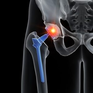 DJO Encore Hip Replacement recall