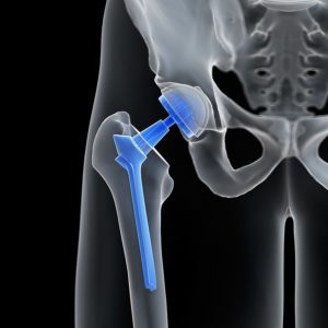 Zimmer Hip Replacement Lawyer