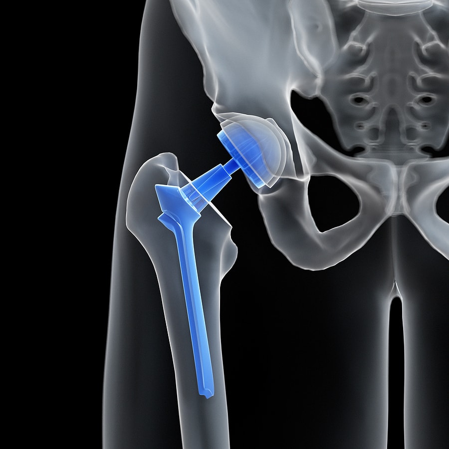 Zimmer Hip Replacement Attorney in Florida