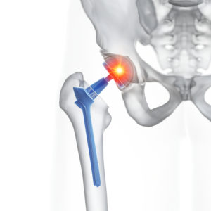 Hip Replacement Revision Surgery