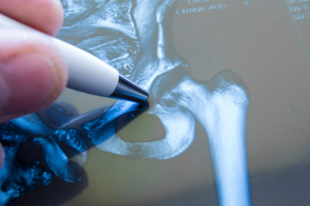 How Does a Hip Replacement Work Sibley Dolman Gipe Accident Injury Lawyers, PA