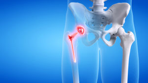 Omnilife Hip Replacement Attorneys
