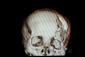 skull fracture traumatic brain injury lawsuit claim attorney Florida