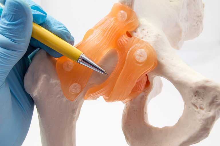 Biomet Hip Replacement Attorneys Dolman Law Group