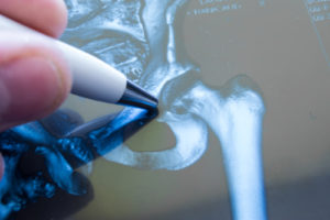 Stryker Hip Replacement Lawsuits
