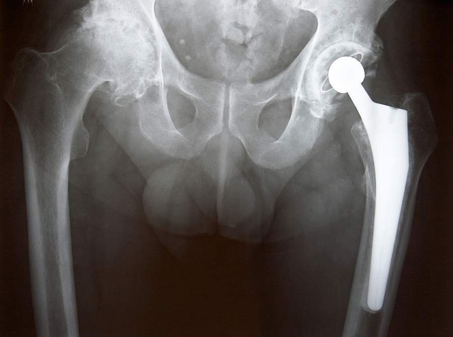 Stryker Hip Replacement Lawyer in Florida Free Consultation