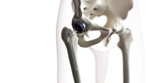 Wright Hip Replacement Lawyer