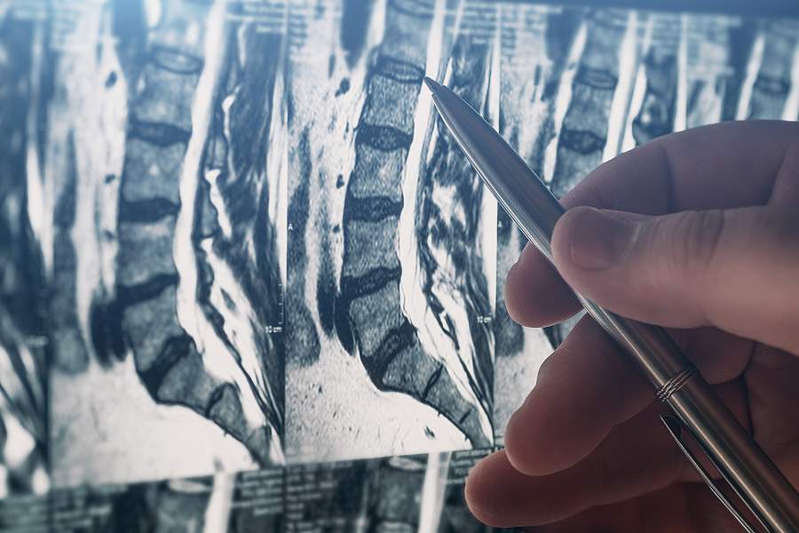 Do I Need Spinal Fusion Surgery (ACDF) After My Accident - Dolman Law Group
