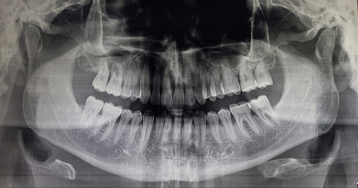 dental injury car accident injury lawsuit claim attorney lawyer Florida