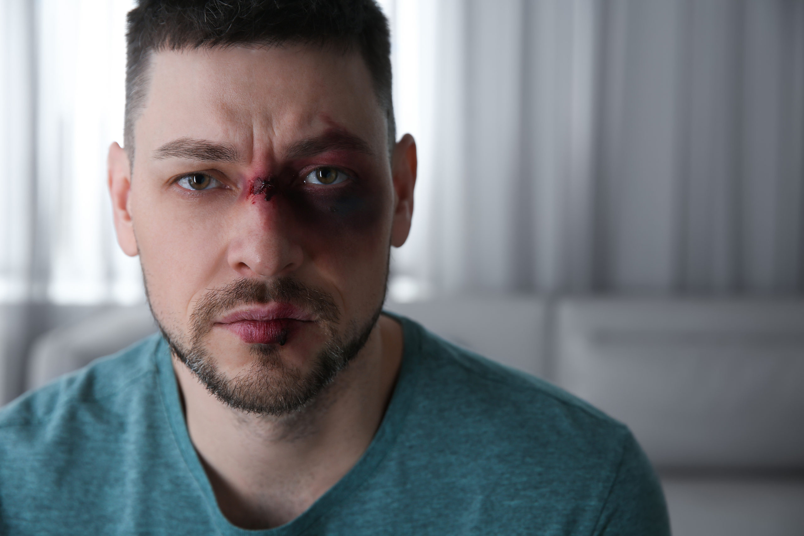 Florida facial injury car accident lawsuit claim attorney lawyer damages case