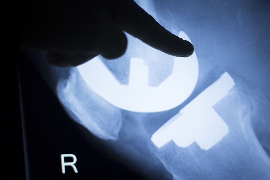 defective hip replacement implant