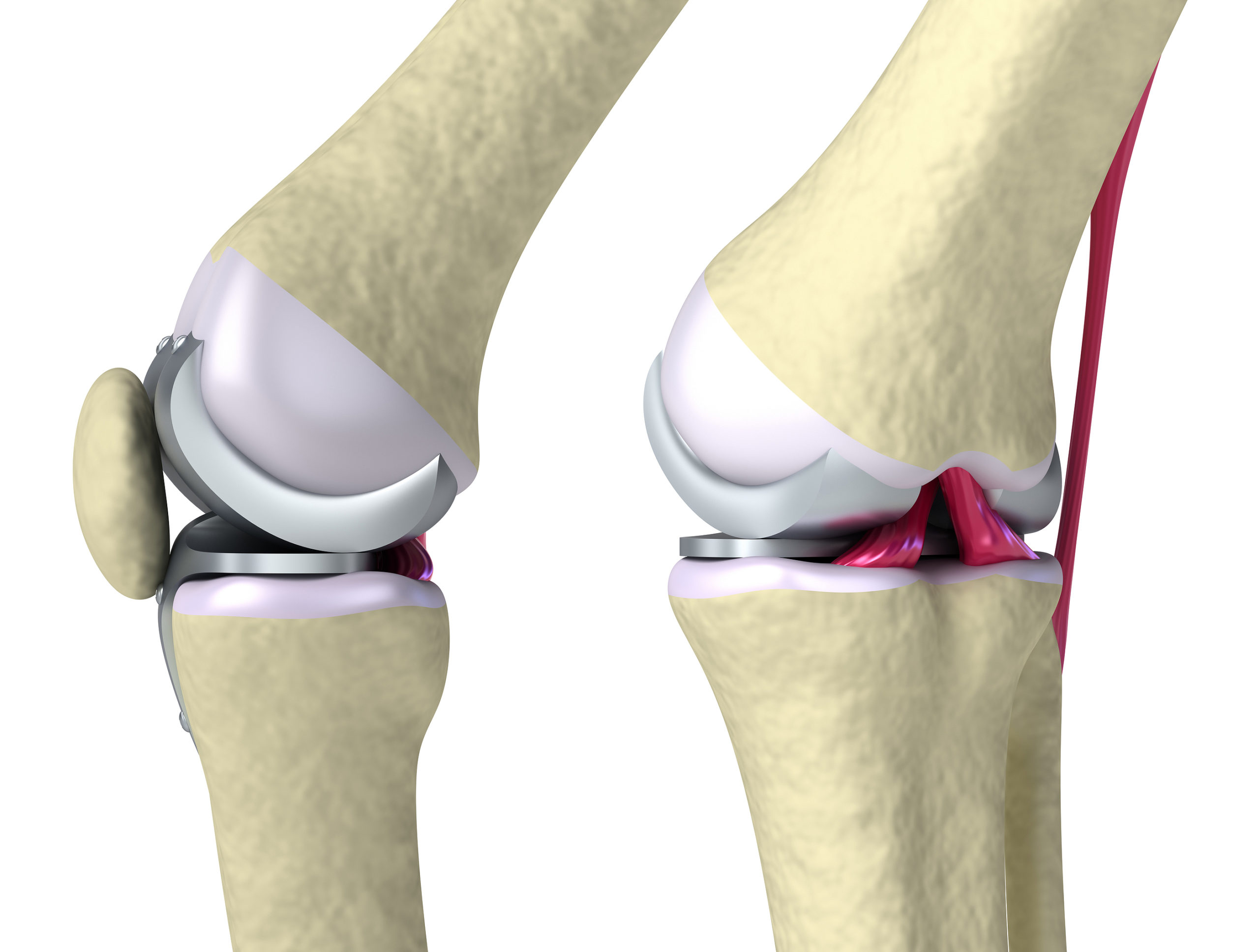 knee orthopedic device implant