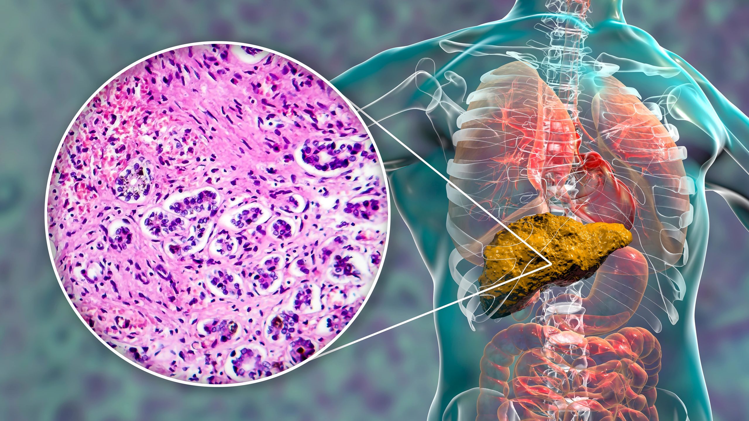 Hepatic Steatosis From Camp Lejeune