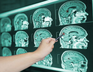 brain scan, traumatic brain injury