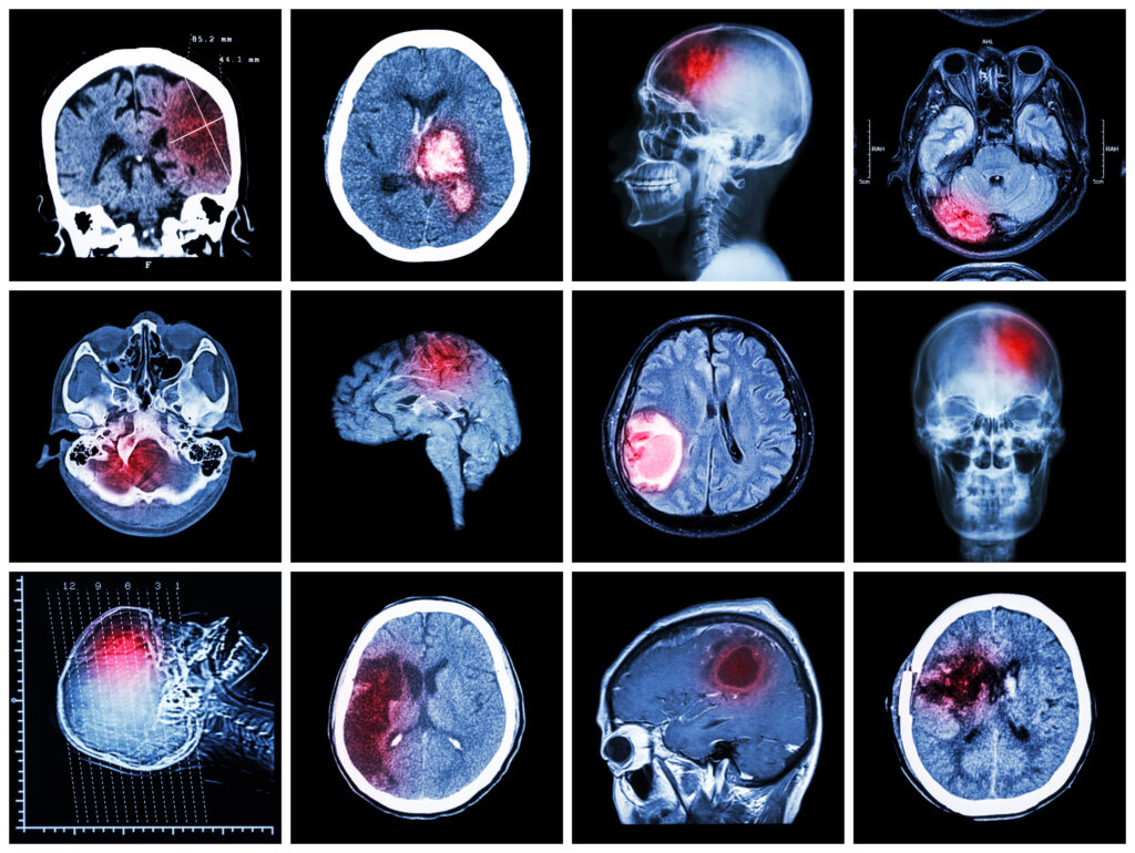 Massachusetts Brain Injury Lawyer