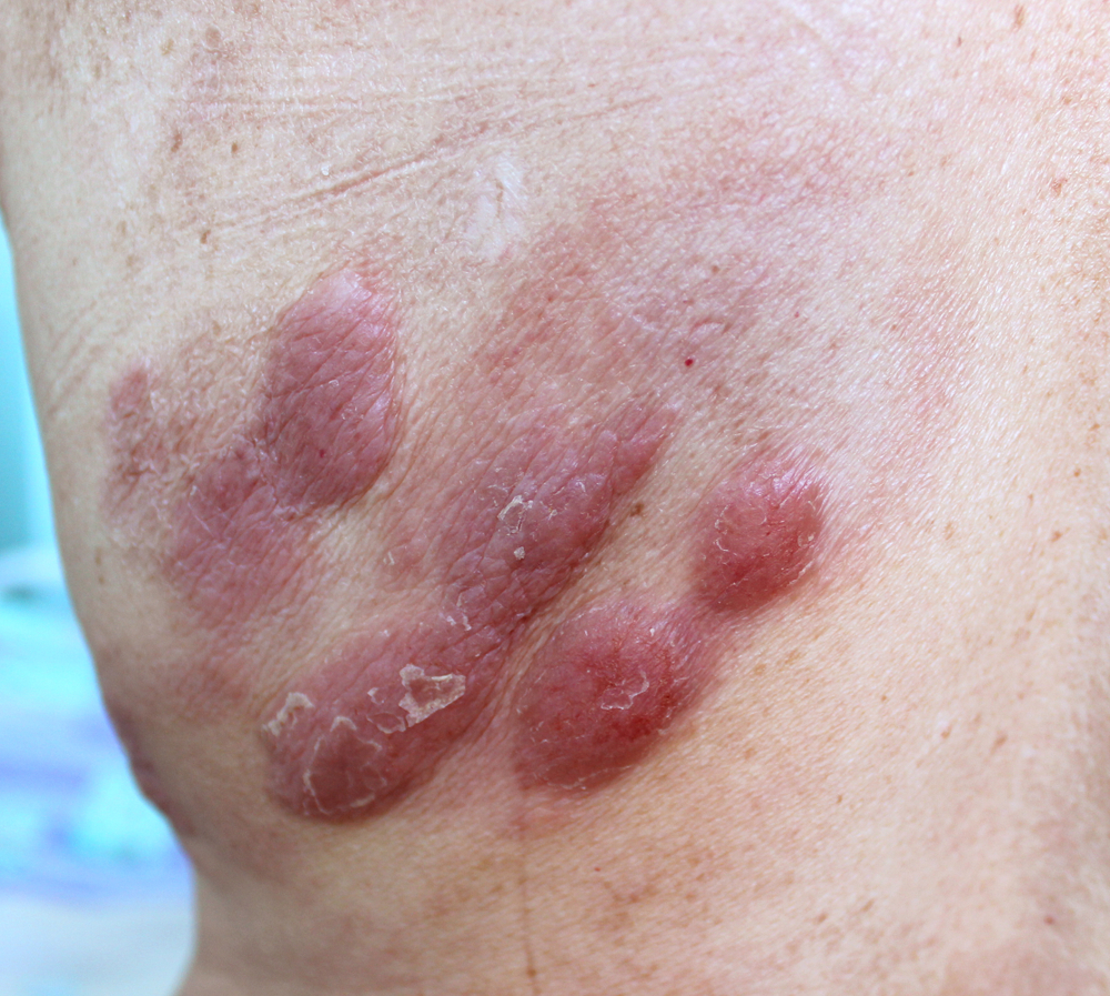 cutaneous t cell lymphoma possibly from Dupixent