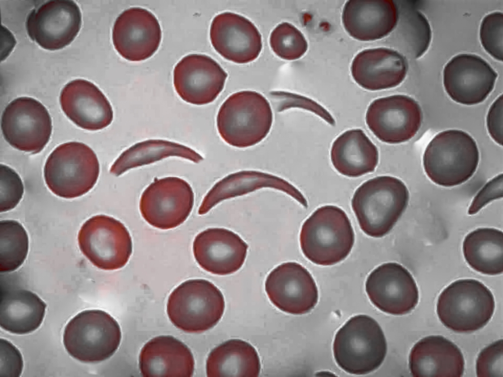 Photo of sickle cell syndrome