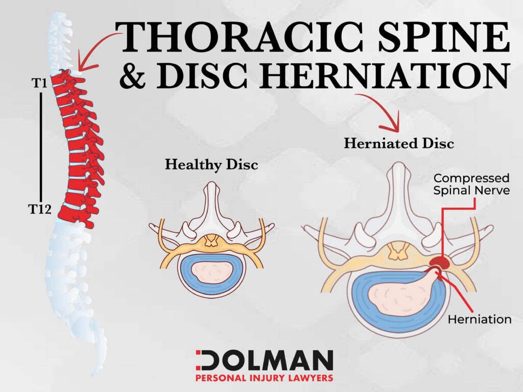 Thoracic Spine and Herniated Disc - Dolman Law Group