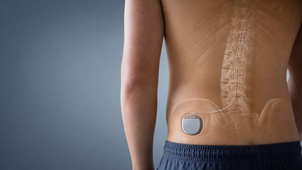 Medical illustration of a spinal cord stimulator implanted in the lower back with electrode leads extending along the spine.